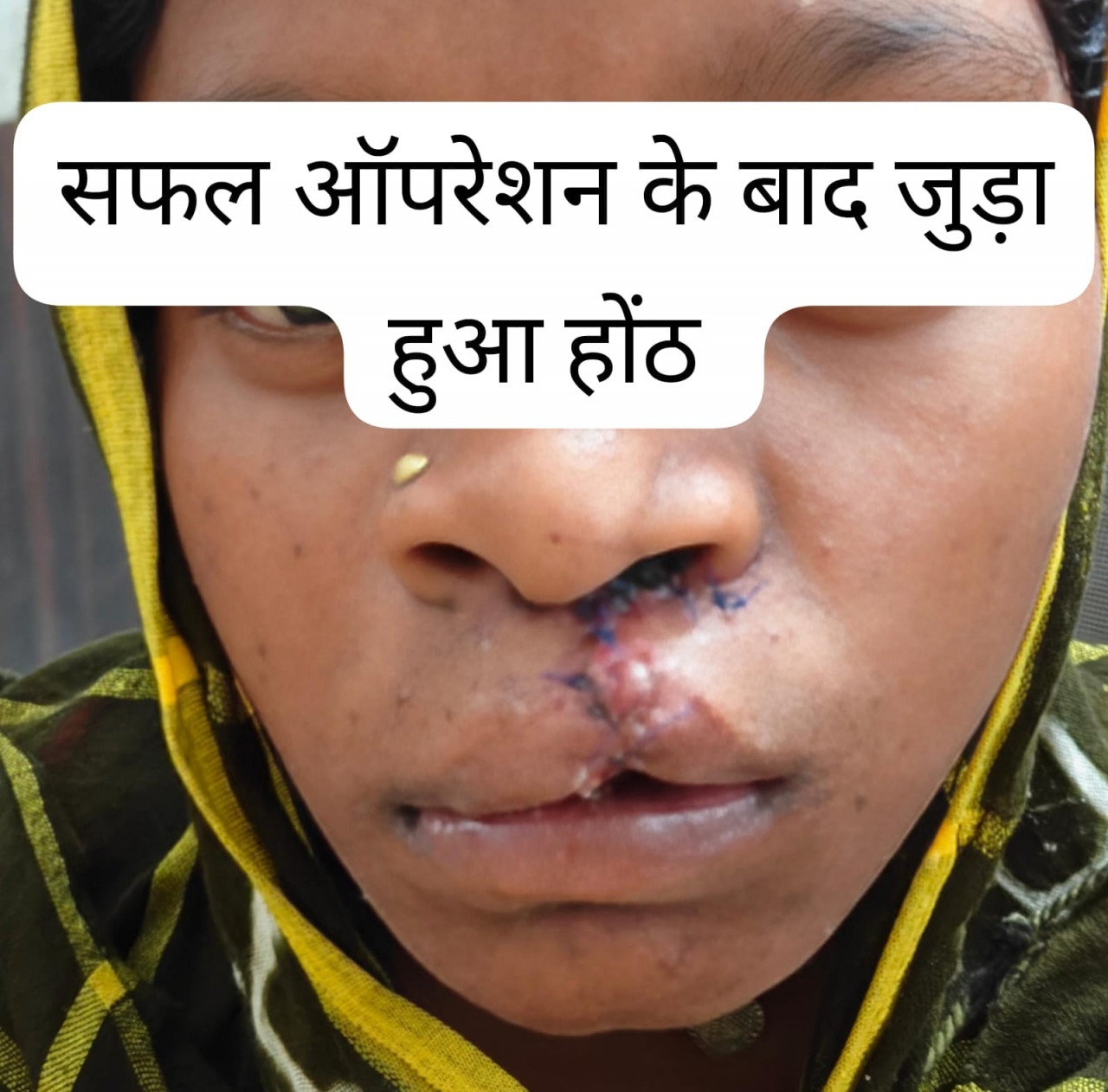 सफल सर्जरी से भीमे हेमला के चेहरे पर लौटी मुस्कान, जन्मजात होंठ की विकृति का हुआ सफल उपचार